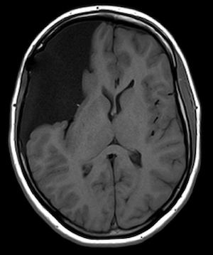 image radiographique d'un kyste arachnoïdien dans le cerveau.